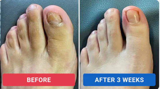 Lunvera™ Nail Repairs Patches